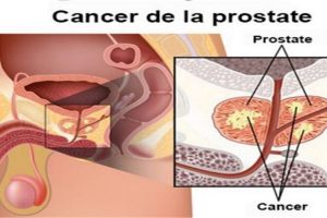 cancer de la prostate definition